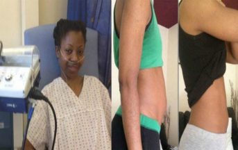 Ha la pancia gonfia e per depurarsi diventa vegana: dopo alcuni mesi la terribile diagnosi