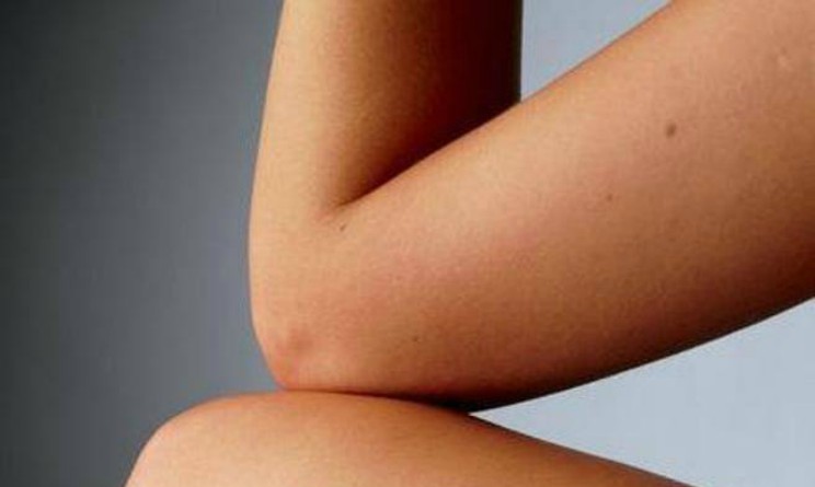 Le celebrità che ebbero la psoriasi