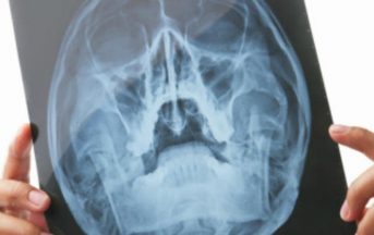 Tumore al cervello: in arrivo nuova tecnica laser che distrugge il cancro