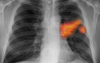 Tumori: nascono a Padova i sensori nanotecnologici in grado di scoprirli