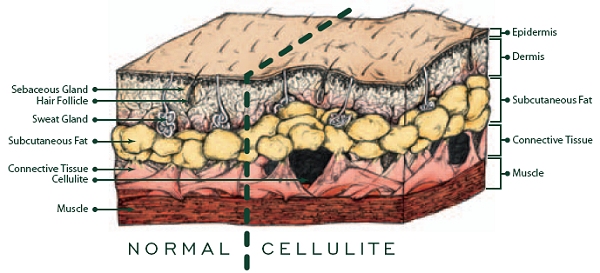 Cellulite schema