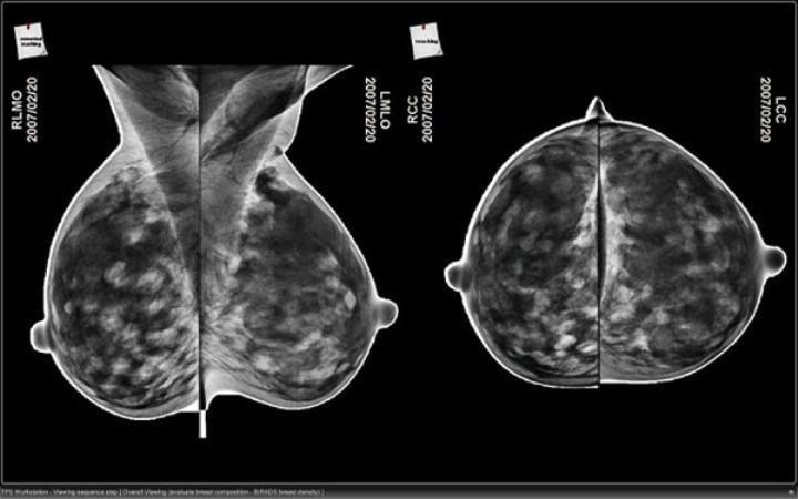 Mammografia 3D: Il Nuovo Test Di Prevenzione Del Cancro Al Seno - UrbanPost