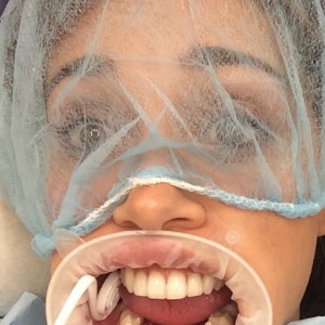 Belen Rodriguez dentista su Instagram