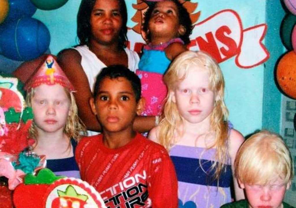 Figli albini nati da madre di colore