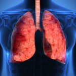 cancro al polmone nuova immunoterapia