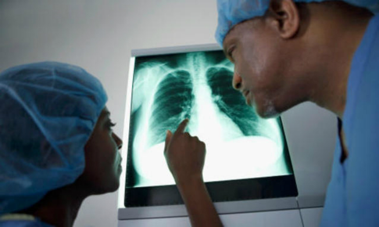 Tumore al polmone sintomi tra le cause anche un virus