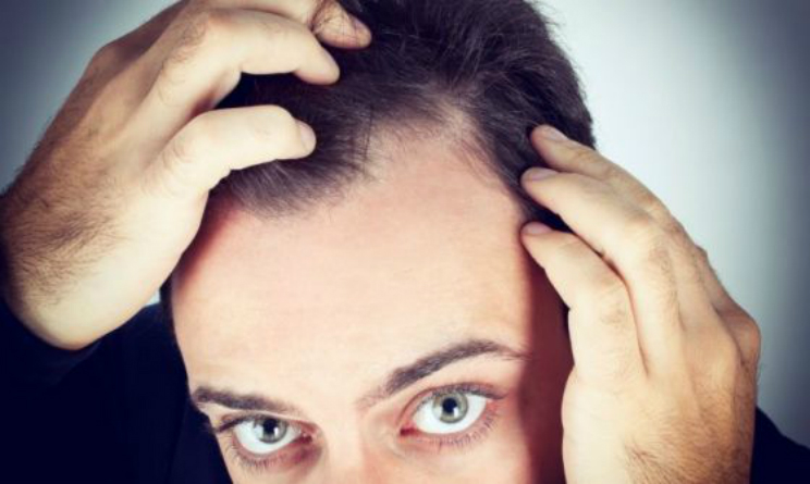 Calvizie e perdita di capelli, gli uomini bassi sono piu a rischio