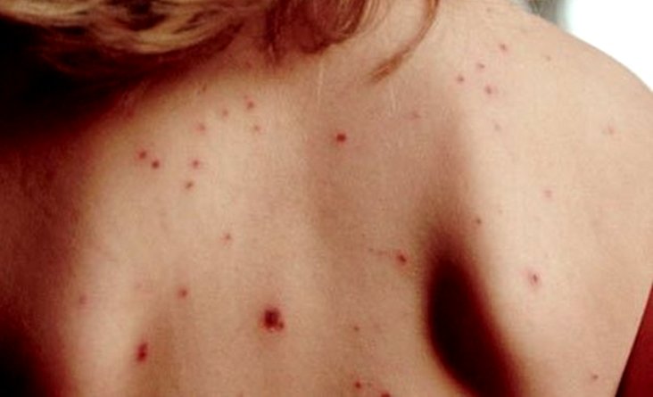morbillo morto bimbo 10 mesi a catania