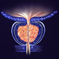 effetto della prostatite