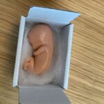 aborto feto