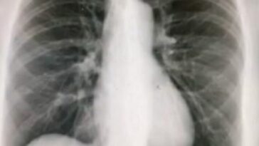 radiografia torace